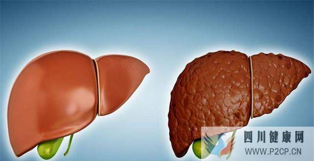 肝病大多是“拖”出来的?常吃3物,排毒养肝,或许肝病悄悄恢复(图1) 肝病大多是“拖”出来的?常吃3物,排毒养肝,或许肝病悄悄恢复(图1)