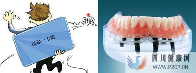 廊坊人种植牙费用可以报销吗?(2022年试管婴儿费用医保可以报销吗)(图1) 廊坊人种植牙费用可以报销吗?(2022年试管婴儿费用医保可以报销吗)(图1)