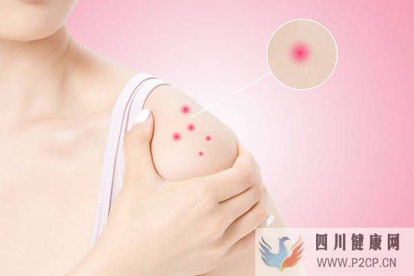 花生过敏同时会对什么过敏容易引起过敏的食物(图2) 花生过敏同时会对什么过敏容易引起过敏的食物(图2)