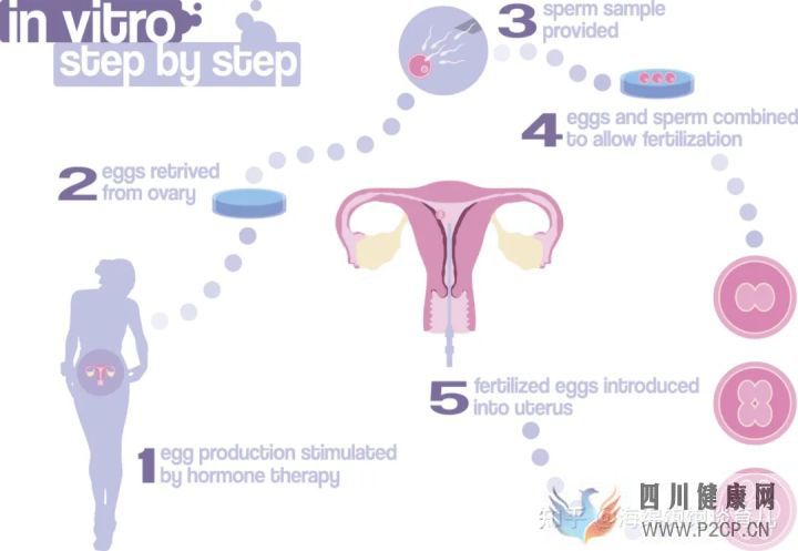 试管婴儿1代、2代、3代、4代哪个最好真实操作过...(第二代试管婴儿成功率有多少)(图4) 试管婴儿1代、2代、3代、4代哪个最好真实操作过...(第二代试管婴儿成功率有多少)(图4)