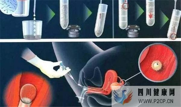 试管婴儿移植成功率和移植的胚胎多少有关系么移植后需要注意哪些(第二代试管婴儿成功率有多少)(图1) 试管婴儿移植成功率和移植的胚胎多少有关系么移植后需要注意哪些(第二代试管婴儿成功率有多少)(图1)