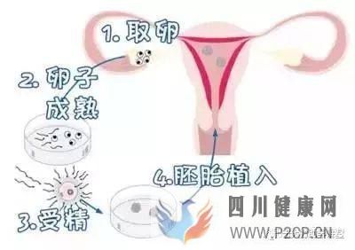 试管婴儿的一个基本流程和周期时间(二代试管婴儿需要多长时间)(图2)
