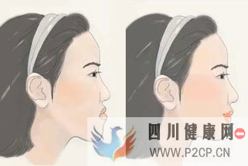 儿童地包天矫正需要多长时间(二代试管婴儿需要多长时间)(图1) 儿童地包天矫正需要多长时间(二代试管婴儿需要多长时间)(图1)