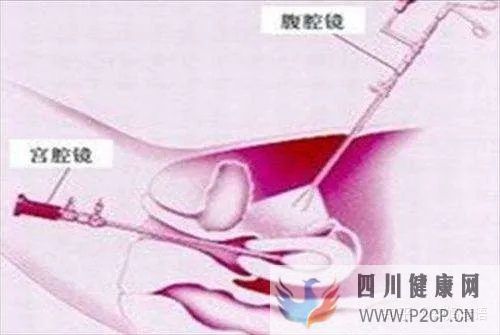 输卵管堵塞到底是先做手术,还是直接试管婴儿(女方输卵管堵塞做试管婴儿需要多长时间)(图7) 输卵管堵塞到底是先做手术,还是直接试管婴儿(女方输卵管堵塞做试管婴儿需要多长时间)(图7)