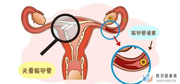 输卵管堵塞做试管婴儿会引起宫外孕吗？不要再听信谣言了(女方输卵管堵塞做试管婴儿需要多长时间)(图1)