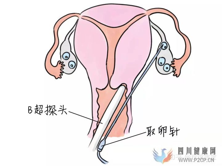 很多人说试管婴儿可能不会是自己亲生的,这是真的...(试管婴儿90%不是自己的)(图1) 很多人说试管婴儿可能不会是自己亲生的,这是真的...(试管婴儿90%不是自己的)(图1)
