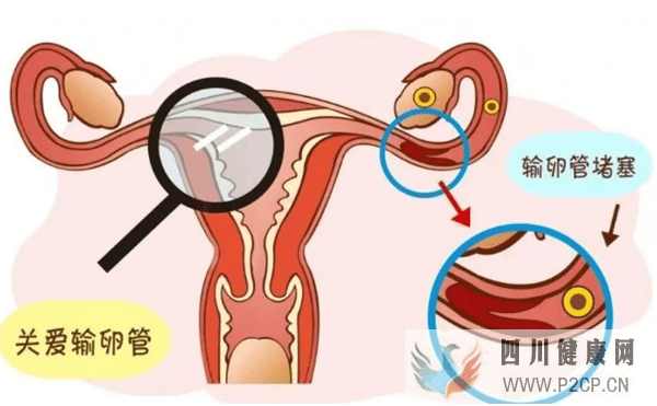 试管婴儿有哪些适应症(试管婴儿90%不是自己的)(图1) 试管婴儿有哪些适应症(试管婴儿90%不是自己的)(图1)
