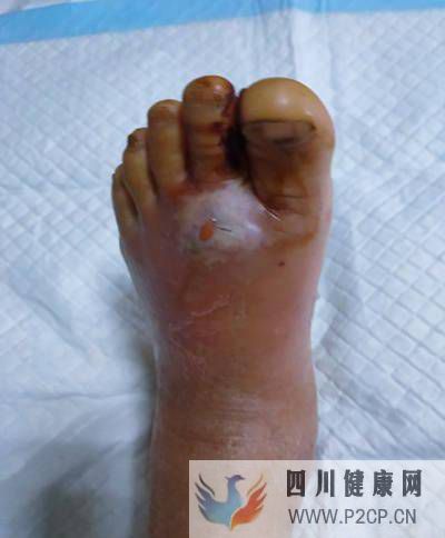 糖尿病患者出现浮肿,要警惕是糖尿病肾病惹的祸(图1) 糖尿病患者出现浮肿,要警惕是糖尿病肾病惹的祸(图1)