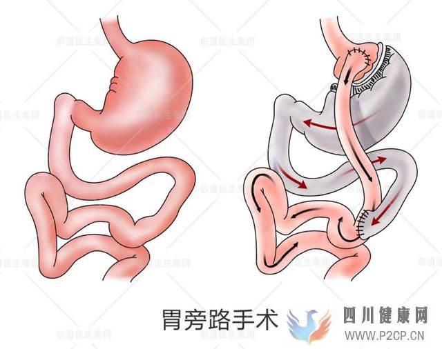 这个方法不仅能减肥，还能治糖尿病！(图1)
