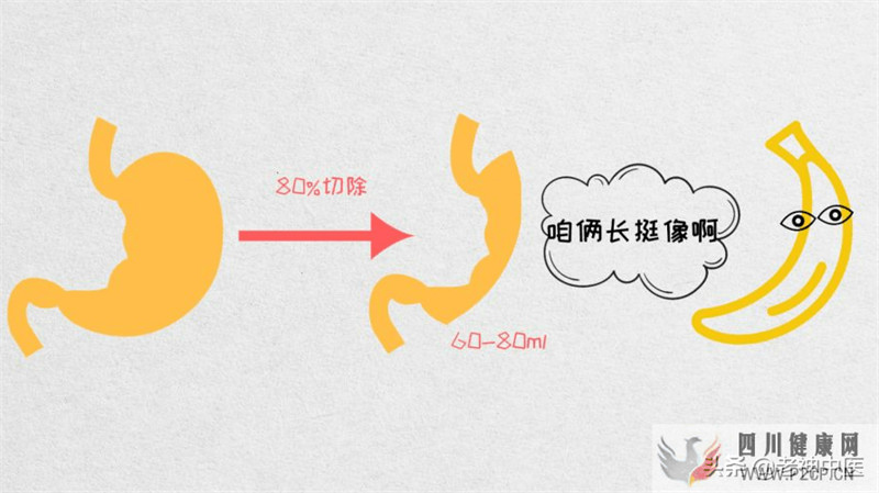 手术治疗糖尿病,可以根治糖尿病吗?(图2) 手术治疗糖尿病,可以根治糖尿病吗?(图2)