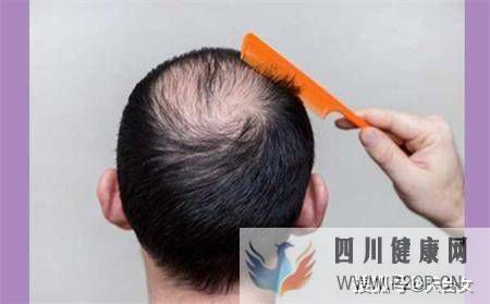 男性脱发有哪些特征?怎么判断自己是不是男性脱发呢?(图1) 男性脱发有哪些特征?怎么判断自己是不是男性脱发呢?(图1)