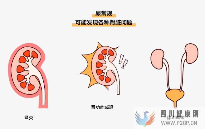 易加医带你涨知识:尿常规结果居然能看出这么多问题!(图2) 易加医带你涨知识:尿常规结果居然能看出这么多问题!(图2)