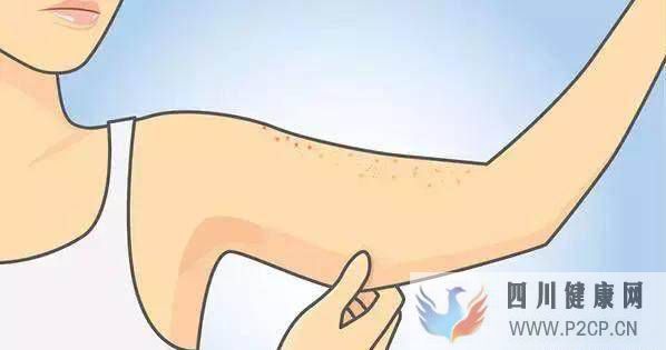 得了鸡皮肤怎么办?如何改善难缠的“鸡皮肤”?(图1) 得了鸡皮肤怎么办?如何改善难缠的“鸡皮肤”?(图1)