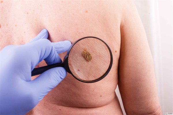 皮肤也会长癌?皮肤出现这4种现象,小心是皮肤癌来“报道”!(图1) 皮肤也会长癌?皮肤出现这4种现象,小心是皮肤癌来“报道”!(图1)