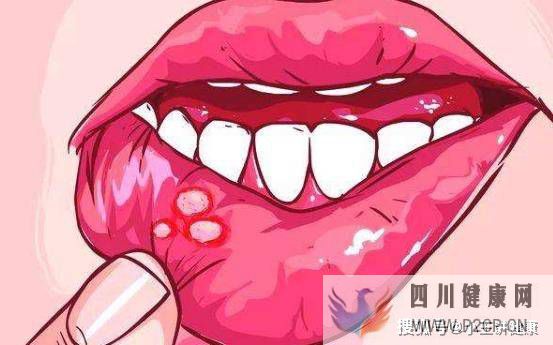 口腔溃疡是怎么引起的?口腔溃疡有哪些危害?(图1) 口腔溃疡是怎么引起的?口腔溃疡有哪些危害?(图1)