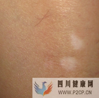白癜风初期的症状是什么样的(图1) 白癜风初期的症状是什么样的(图1)