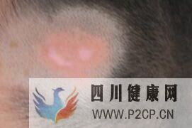 儿童白癜风早期症状是什么样的(图1) 儿童白癜风早期症状是什么样的(图1)