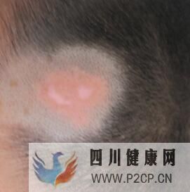 儿童白癜风早期症状是什么样的(图2) 儿童白癜风早期症状是什么样的(图2)