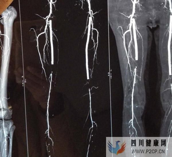 糖尿病并发症足部溃疡的早期病因有哪些?(图1) 糖尿病并发症足部溃疡的早期病因有哪些?(图1)