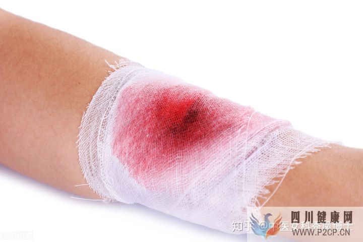 糖尿病的5大早期症状(图3) 糖尿病的5大早期症状(图3)