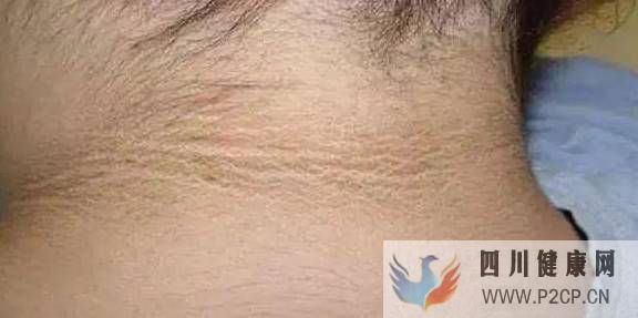 脖子上出现这个东西,是糖尿病的表现!赶快重视起来(图1) 脖子上出现这个东西,是糖尿病的表现!赶快重视起来(图1)