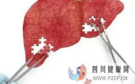 引起肝硬化的原因是什么(图2) 引起肝硬化的原因是什么(图2)