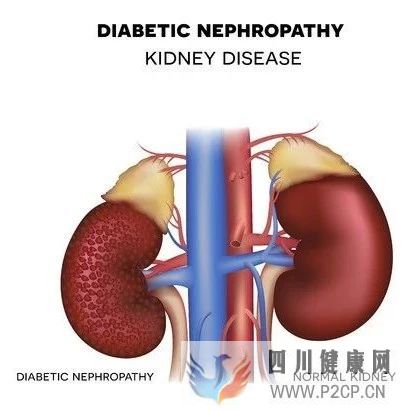 得了糖尿病肾病怎么办?(图1) 得了糖尿病肾病怎么办?(图1)