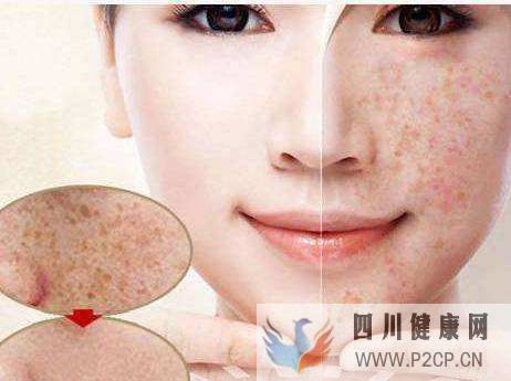 激素脸好的症状有哪些激素脸怎么有效治疗(图1) 激素脸好的症状有哪些激素脸怎么有效治疗(图1)