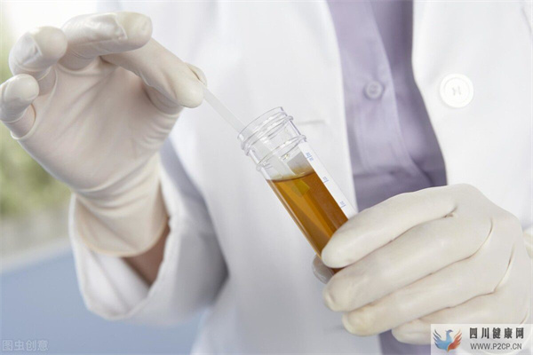 IGA肾病的症状有哪些?有这些症状的人需警惕,早发现早治疗(图1) IGA肾病的症状有哪些?有这些症状的人需警惕,早发现早治疗(图1)