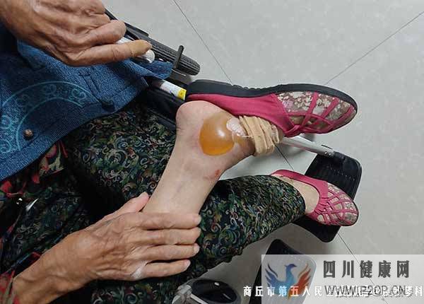 糖尿病足为什么很难治?怎么治疗才能好?(图1) 糖尿病足为什么很难治?怎么治疗才能好?(图1)