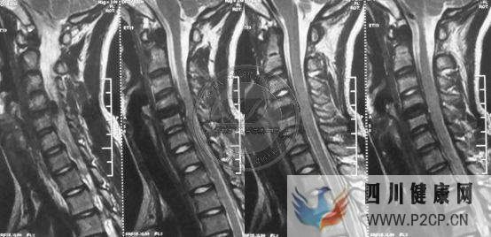 平山病的症状表现有哪些?(图1) 平山病的症状表现有哪些?(图1)