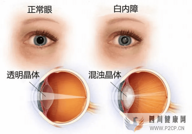 泉州白内障专家李学喜院长给白内障患者的8大建议!(图1) 泉州白内障专家李学喜院长给白内障患者的8大建议!(图1)