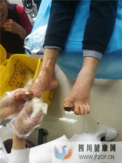 糖尿病患者双脚大脚趾同时出现发黑溃烂,典型的糖尿病足干性坏疽(图1) 糖尿病患者双脚大脚趾同时出现发黑溃烂,典型的糖尿病足干性坏疽(图1)