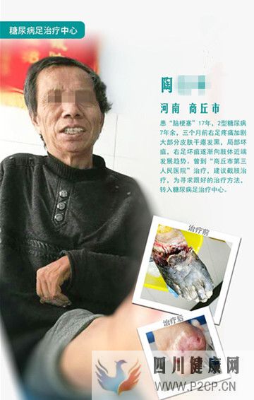 糖尿病患者为什么会得糖尿病足,应该怎么治疗?(图1) 糖尿病患者为什么会得糖尿病足,应该怎么治疗?(图1)