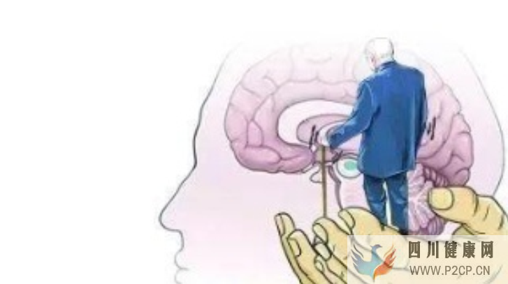 小脑萎缩都有哪些症状?要怎么治疗?(图1) 小脑萎缩都有哪些症状?要怎么治疗?(图1)