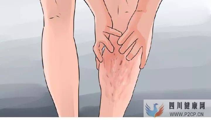糖尿病患者腿抽筋是不是缺钙?(图1) 糖尿病患者腿抽筋是不是缺钙?(图1)