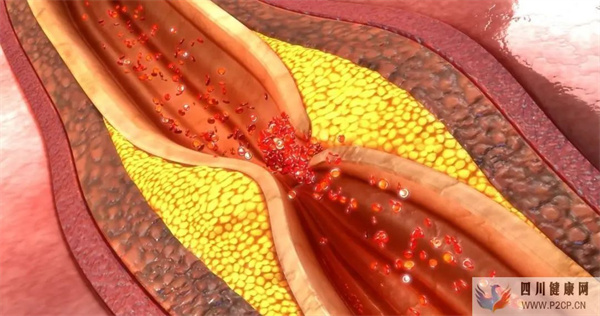 降低动脉粥样硬化风险?干细胞疗法有四大优势!(图1) 降低动脉粥样硬化风险?干细胞疗法有四大优势!(图1)