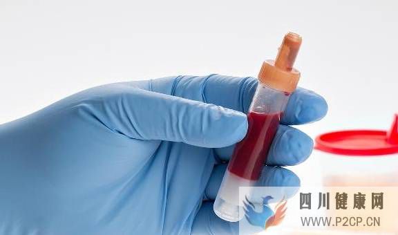 尿糖高等于糖尿病?不,这3个原因可能也会让尿糖升高(图1) 尿糖高等于糖尿病?不,这3个原因可能也会让尿糖升高(图1)