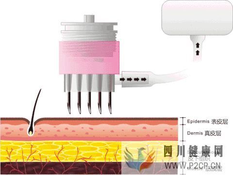 看水光针有依赖性吗?有副作用吗?打了水光针多久见效?(图1) 看水光针有依赖性吗?有副作用吗?打了水光针多久见效?(图1)