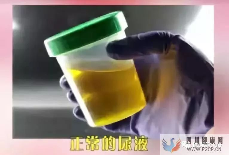 尿液颜色越浅越好吗?有这些特征的可能是癌症信号!(图1) 尿液颜色越浅越好吗?有这些特征的可能是癌症信号!(图1)