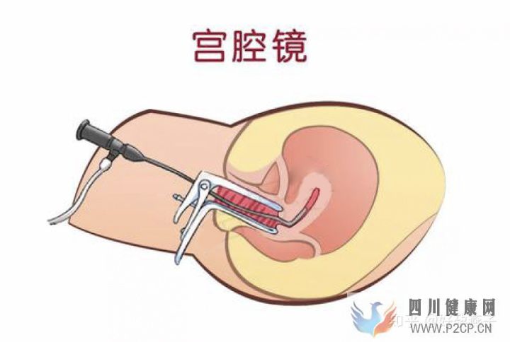 不孕症的自我诊断(图5)