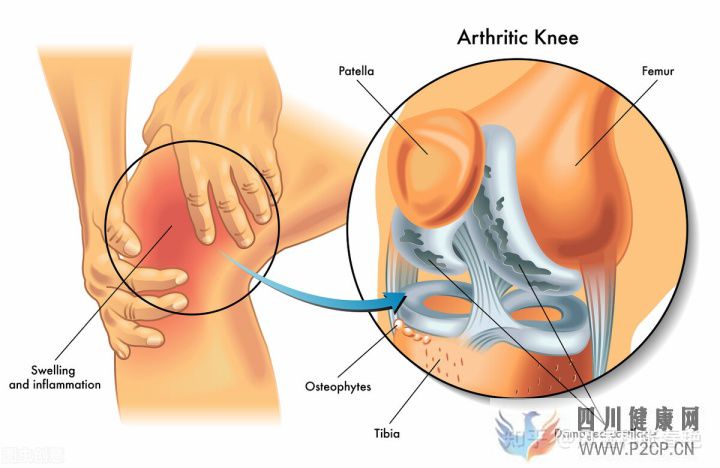 风湿病有哪些症状表现身体上出现这些征兆要注意了(图3) 风湿病有哪些症状表现身体上出现这些征兆要注意了(图3)
