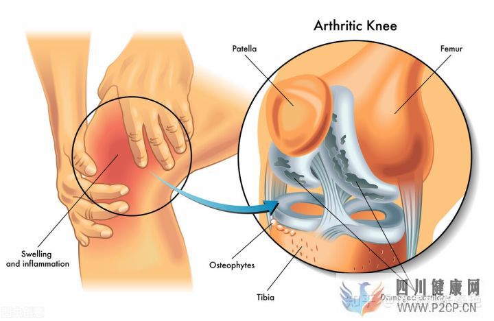 风湿病有哪些症状表现身体上出现这些征兆要注意了(图4) 风湿病有哪些症状表现身体上出现这些征兆要注意了(图4)