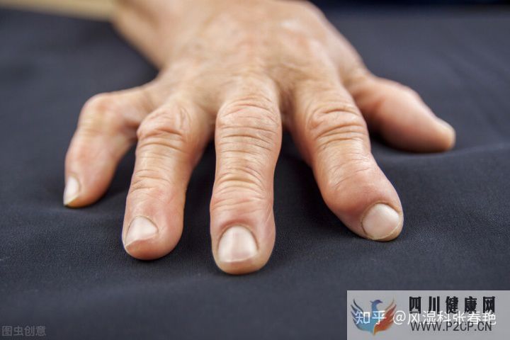 风湿病有哪些症状表现身体上出现这些征兆要注意了(图5) 风湿病有哪些症状表现身体上出现这些征兆要注意了(图5)