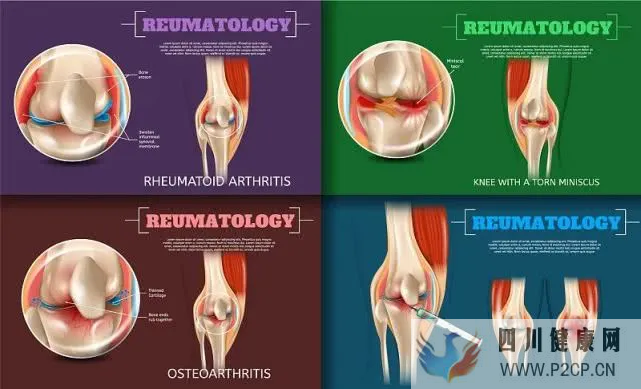 干细胞,类风湿性关节炎的救星!(图1) 干细胞,类风湿性关节炎的救星!(图1)