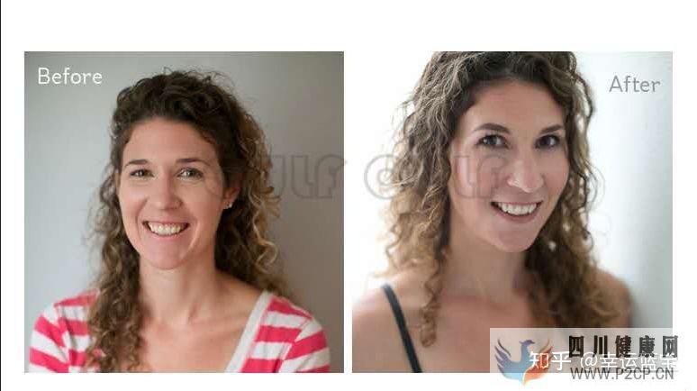 关于干细胞填充要做几次,干细胞填充一般多久才看到...(图12) 关于干细胞填充要做几次,干细胞填充一般多久才看到...(图12)