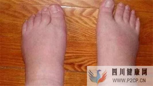 肾病水肿,患者应该怎样辅助治疗呢?(图2) 肾病水肿,患者应该怎样辅助治疗呢?(图2)