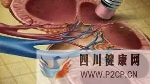 她患糖尿病只有5年,就必须透析治疗,为避免悲剧重演,一定要学会这5个预防糖尿病肾病的方法(图1) 她患糖尿病只有5年,就必须透析治疗,为避免悲剧重演,一定要学会这5个预防糖尿病肾病的方法(图1)