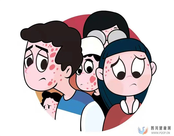 中医中药治疗银屑病有什么方法呢?(图1) 中医中药治疗银屑病有什么方法呢?(图1)