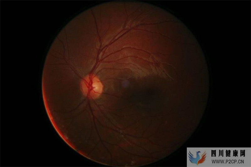 糖尿病肾病的早期信号有哪些？该如何预防？(图1)